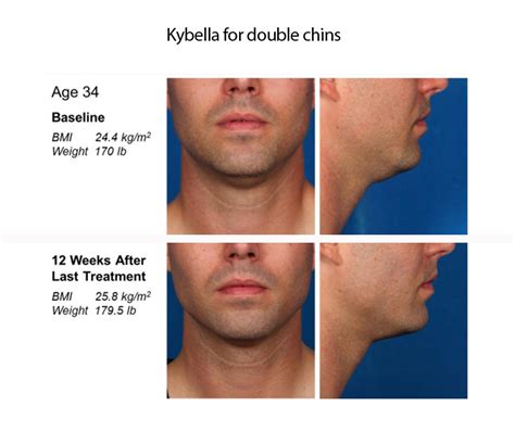 Kybella Injections For Chin Fat What You Need To Know Cosmetic