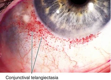 Conjunctiva And Sclera The Massachusetts Eye And Ear