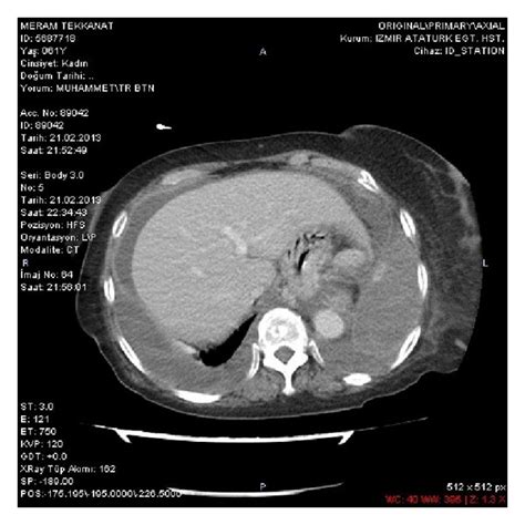 A A Chest Ct Scan Revealed Bilateral Pleural Effusion With A Partial
