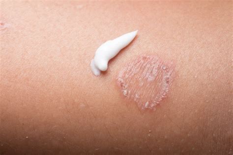 Understanding Fungal Skin Infections Advanced Dermatology Care