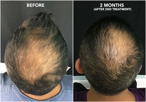 Hair Regrowth Therapy With Acell Prp San Francisco Bay Area Usha