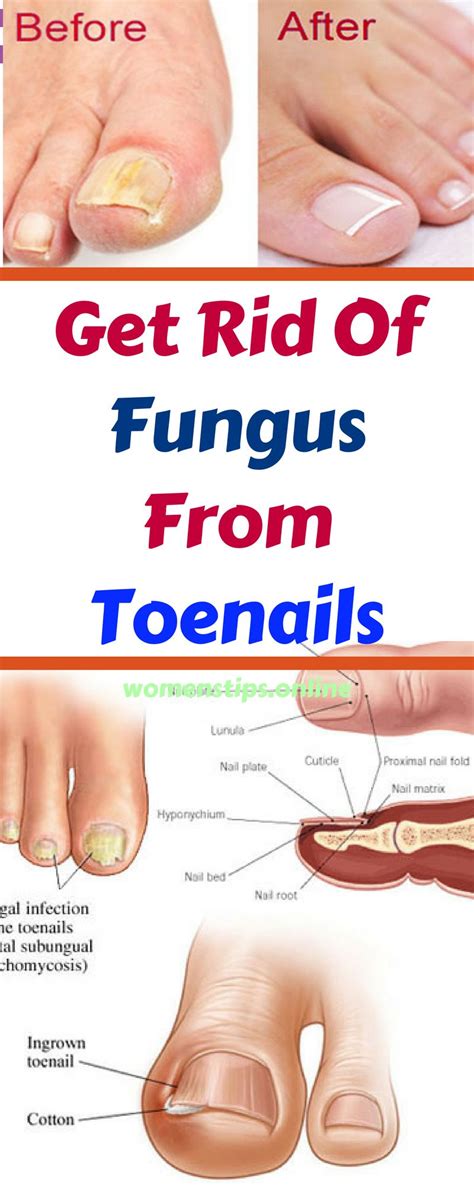 Get Rid Of Fungus From Toenails Womens Tips Toe Nails Fungi Nail