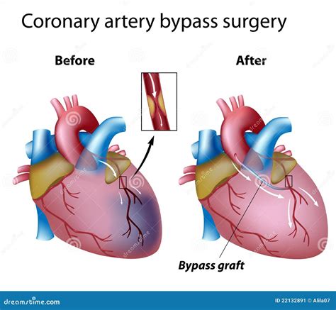 Heart Bypass Surgery Stock Vector Illustration Of Artery 22132891