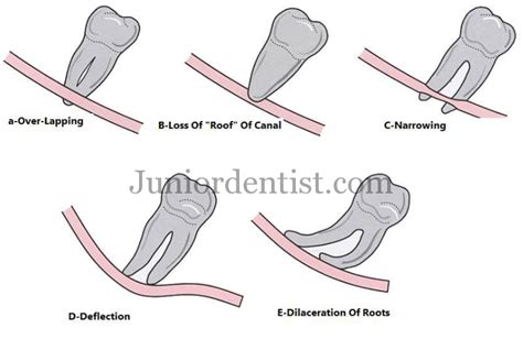 Why Are Wisdom Teeth3rd Molars Most Often Extracted By Dentists