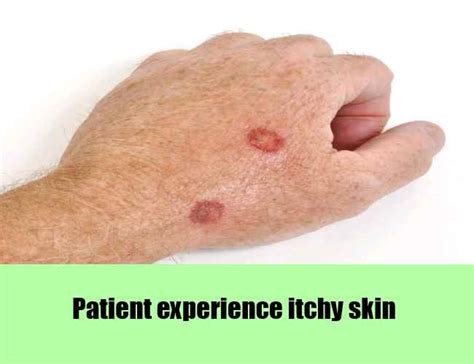 Liver Disease Skin Itching