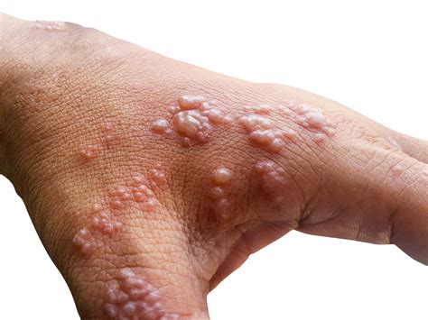 Monkeypox Risk Factors Severity And More News