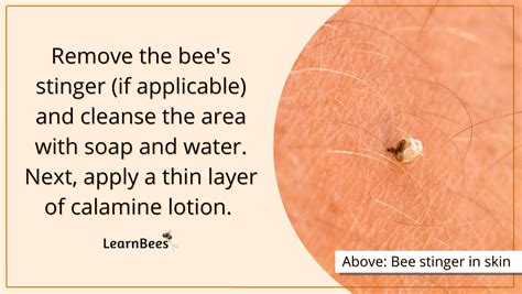 Here S What To Put In A Bee Sting To Relieve Itch Pain Redness