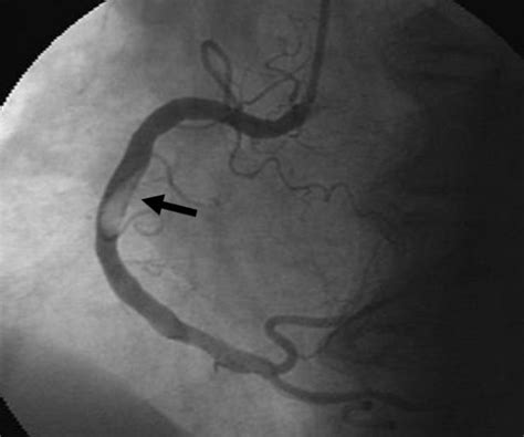 Coronary Angiography Revealing Thrombus Like Filling Defect In The Mid