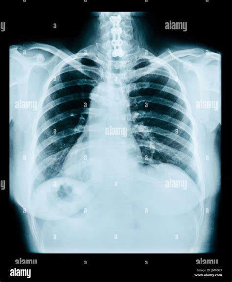 Medical Radiograph Of Thorax Ray Lungs Chest Stock Photo Alamy