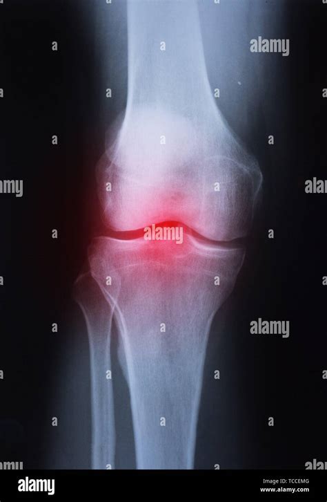 Medical X Ray Knee Joint Image With Arthritis Gout Rheumatoid