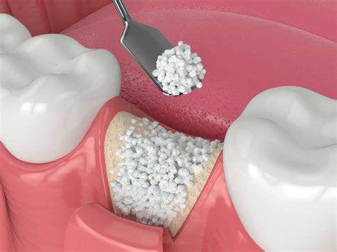 Dental Bone Graft Bone Graft For Dental Implant