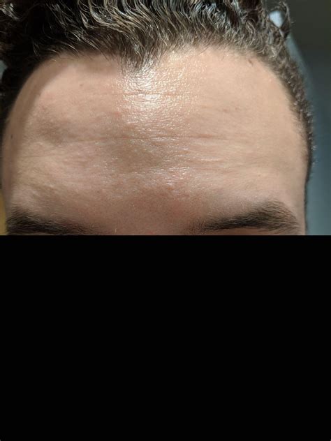 Skin Concern My Forehead Isnt Red Or Even Uneven In Texture But Has