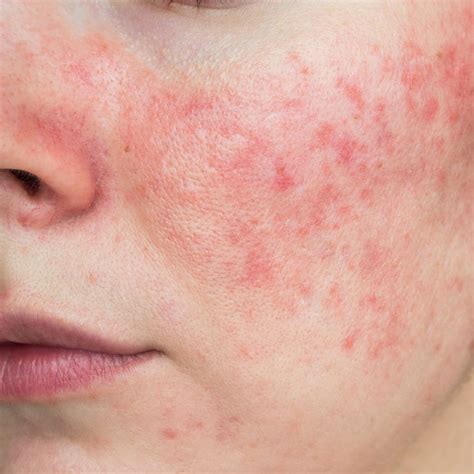 Rosacea Erkennen Und Behandeln Helsana