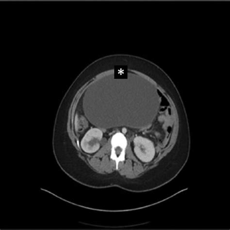 Abdominal Ct Scan Without Contrast Showing The Pelvic Tumor