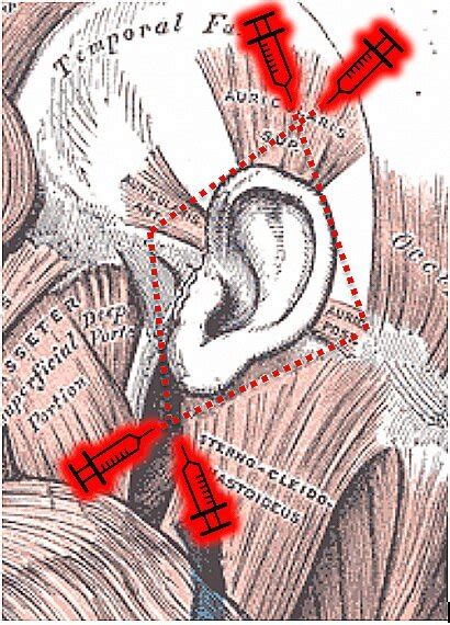 Mastering Minor Care Auricular Hematoma — Taming The Sru