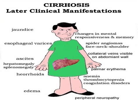 Cirrhosis Of The Liver And The Liver Functions Nurse Nursing Care