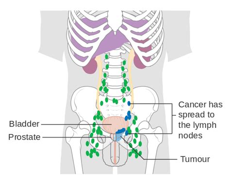 Filediagram Showing Prostate Cancer That Has Spread To The Lymph Nodes