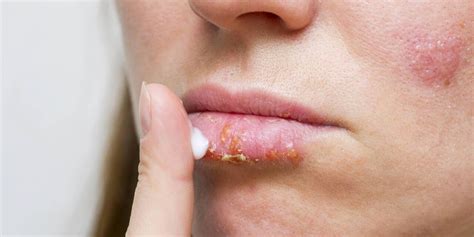 Pictures Of Impetigo On The Lips Compared With A Cold Sore