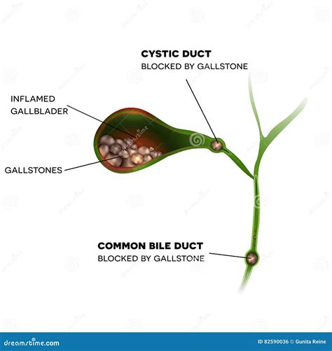 Gallbladder And Stones Stock Vector Illustration Of Common 82590036
