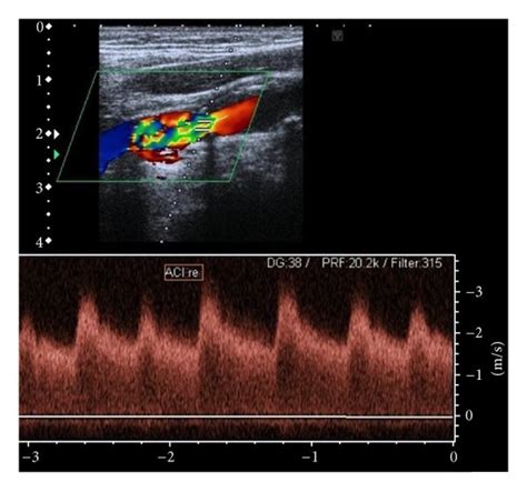 Doppler Ultrasound Assessment Of The Right Internal Cerebral Artery