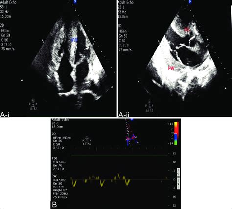 Two Dimensional Echocardiography Showing Myocardial Speckled