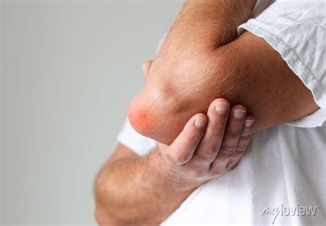 Man Swelling Erythematous Lump Pain Elbow From Olecranon Bursitis