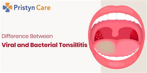 Difference Between Viral And Bacterial Tonsillitis