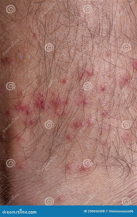 Allergic Reactions To Tick Bites Stock Photo Image Of Arachnids