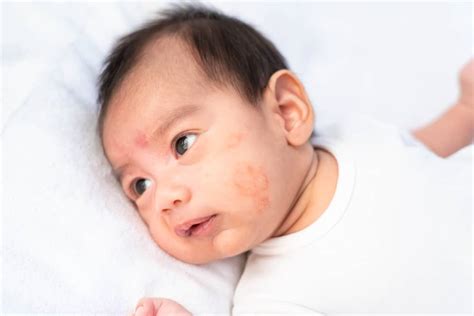 Dermatitis Pada Bayi Penyebab Gejala Perawatan
