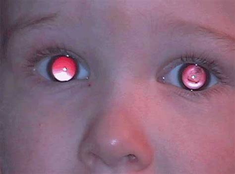 Filling it out only takes two minutes! Congenital cataract. Causes, symptoms, treatment ...
