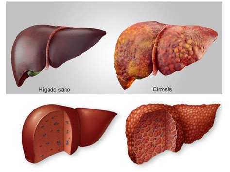 hígado sano vs hígado con cirrosis Nación Farma