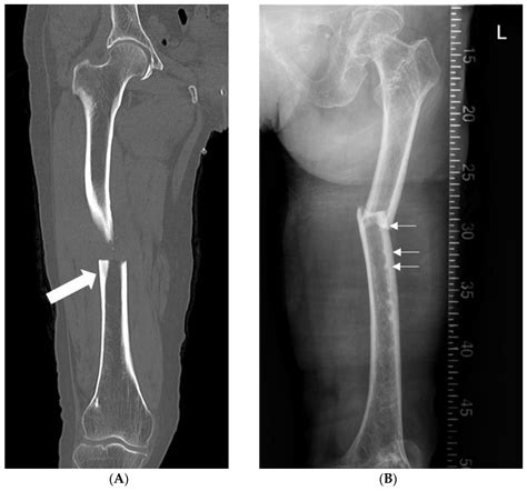 Discover 132 Femoral Nail Xray Latest Vn