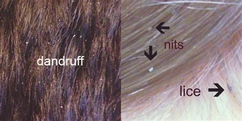 Does hair dye eliminate head lice?you will understand for sure once you use it yourself. Lice vs. Dandruff, Nits & Dry Scalp: What's the Difference ...