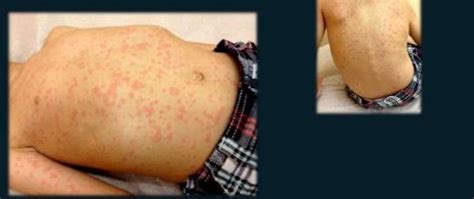 Amoxicillin Rash Pictures Adults Baby Types