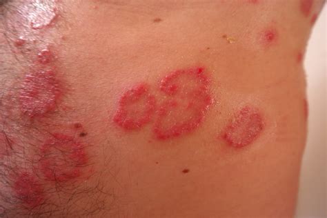 Diagnosis Spotlight Common Rashes And How To Treat Them Part 2
