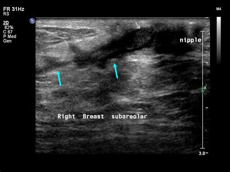 Atlas Of Breast Cancer Early Detection