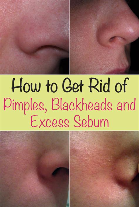 Excessive sebum also causes a lot of hair loss. How to Get Rid of Pimples, Blackheads and Excess Sebum ...