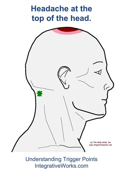Understanding Trigger Points Headache On The Top Of Your Head