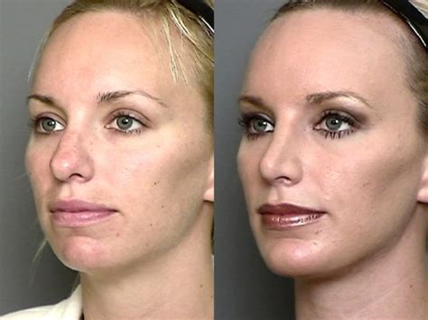 Before And After Patients Before And After Photos Terinomd Dr