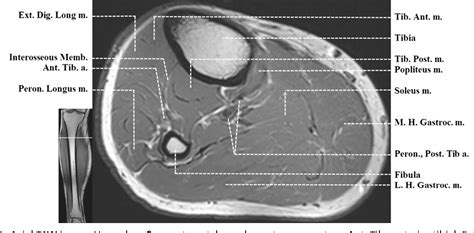 Figure 7 From Normal Mr Imaging Anatomy Of The Thigh And Leg