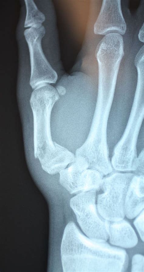 Metacarpal Fractures Melbourne Hand Surgery 2023