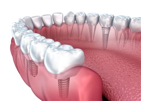 Frequently Asked Questions On Dental Implants Answered