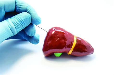 Look beyond liver biopsy for NAFLD diagnosis | MDedge Internal Medicine