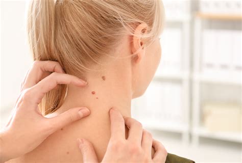 5 home remedies for skin tags tea tree oil acv and more