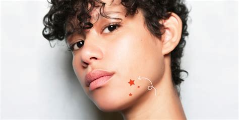 Cystic Acne Causes Symptoms And Treatments