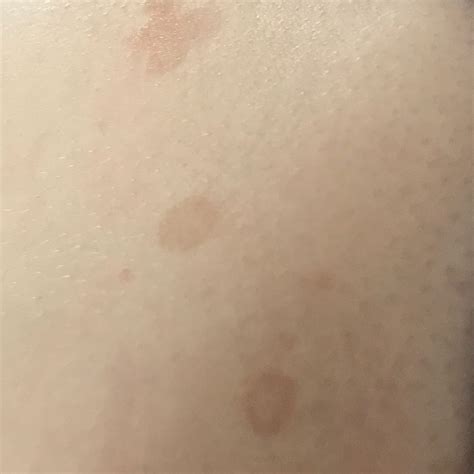 Pityriasis Versicolor Icd 10 B360 Online Consultation Ai