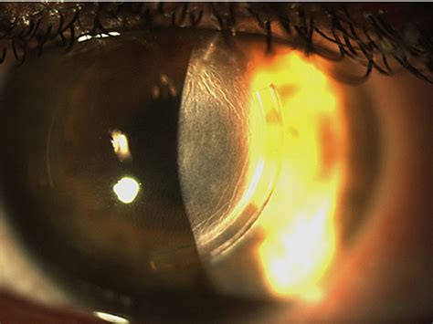 Figure 1 From Combination Of Corneal Crosslinking And Intrastromal
