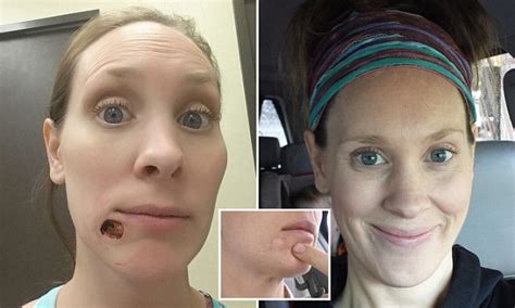 California Mother Dismissed Skin Cancer As A Blackhead Daily Mail Online