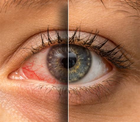 Why Are My Eyes Red And Bloodshot Causes And Treatment Ocuwellness