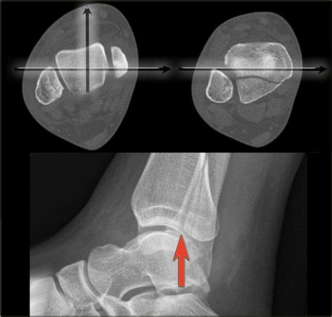 The Radiology Assistant Ankle Fracture Mechanism And Radiography